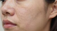 assessing genuine scar reduction