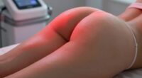 cellulite and stretch mark treatment