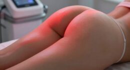 cellulite and stretch mark treatment