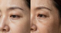 light therapy skin improvements