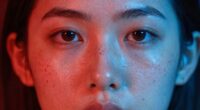 light therapy for acne
